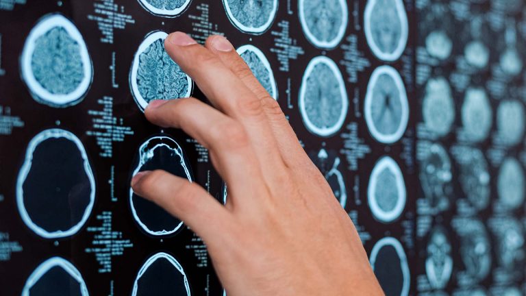 Doctor’s hand pointing at brain scan images.